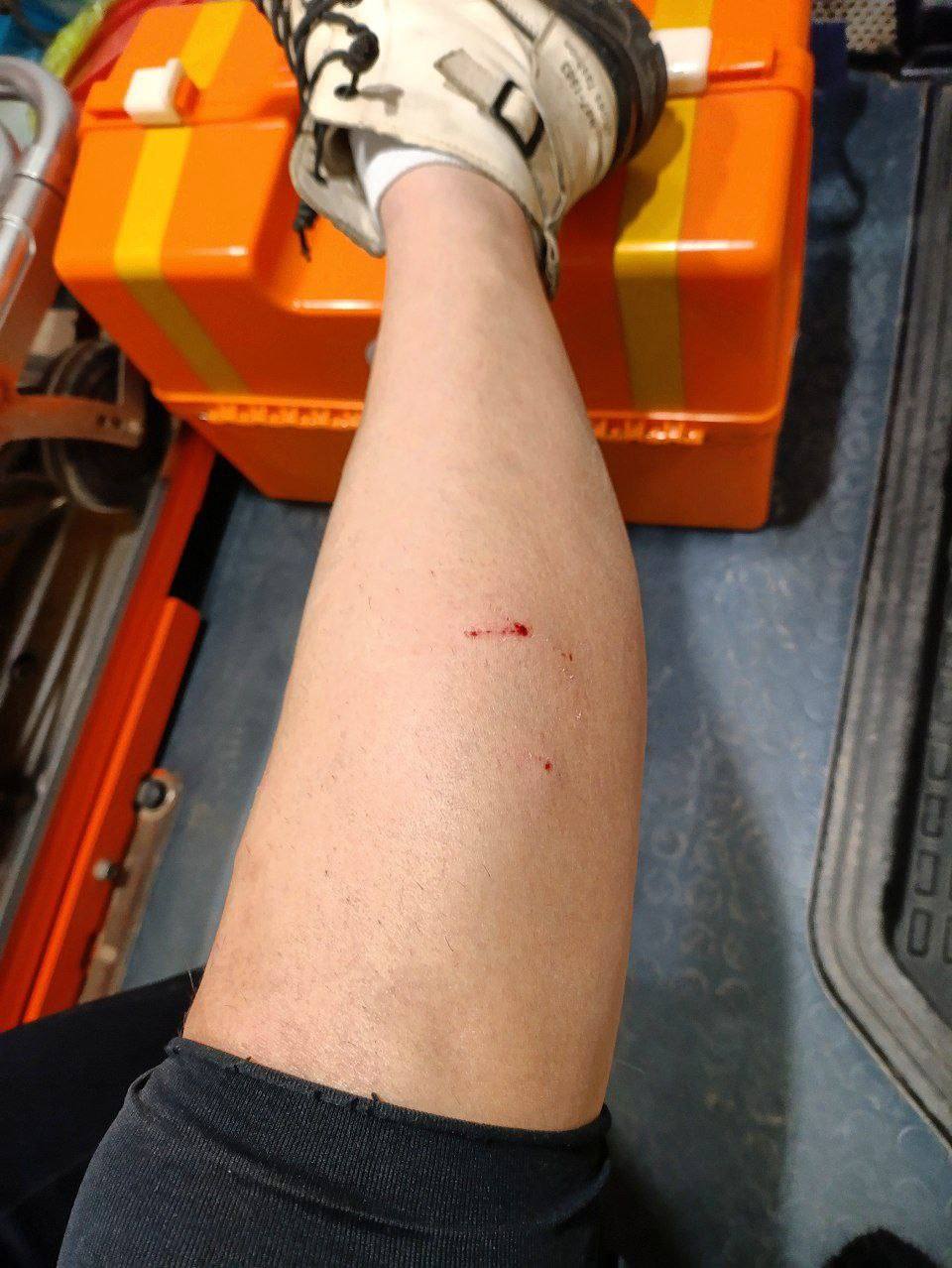 Нападение собак в Луганске: девушка госпитализирована